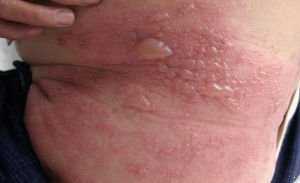 带状疱疹具体的症状有哪些