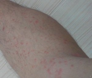 慢性皮炎湿疹有哪些症状