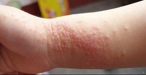 手部湿疹有哪些病因