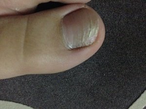 灰指甲有哪些常见的危害
