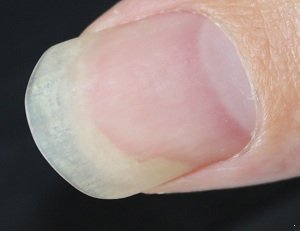 灰指甲有哪些临床症状