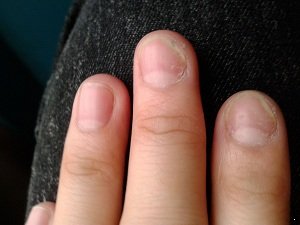 小孩患上灰指甲有哪些症状?