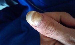 导致灰指甲的因素有哪些