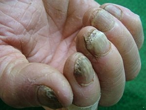 灰指甲有哪些临床表现?